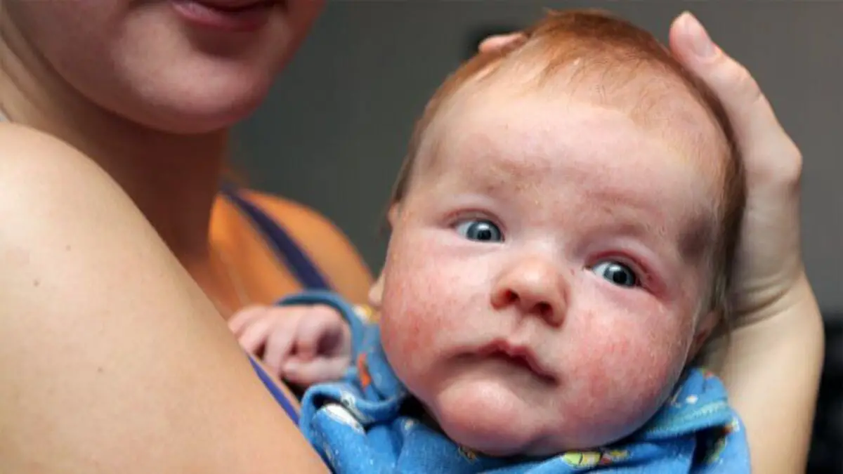 Identifying Early Warning Signs of Eczema in Infants