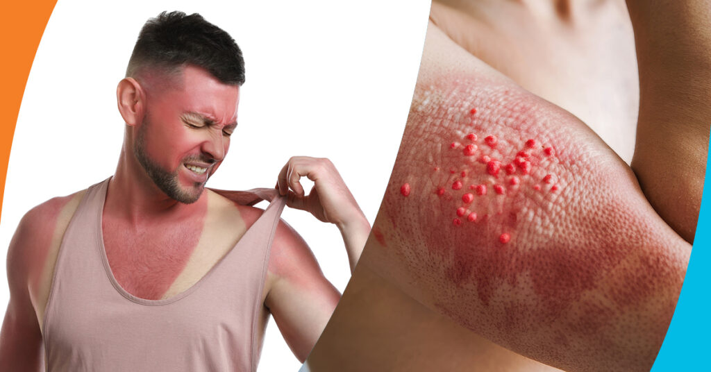 Sun Poisoning: More Than Just a Bad Sunburn